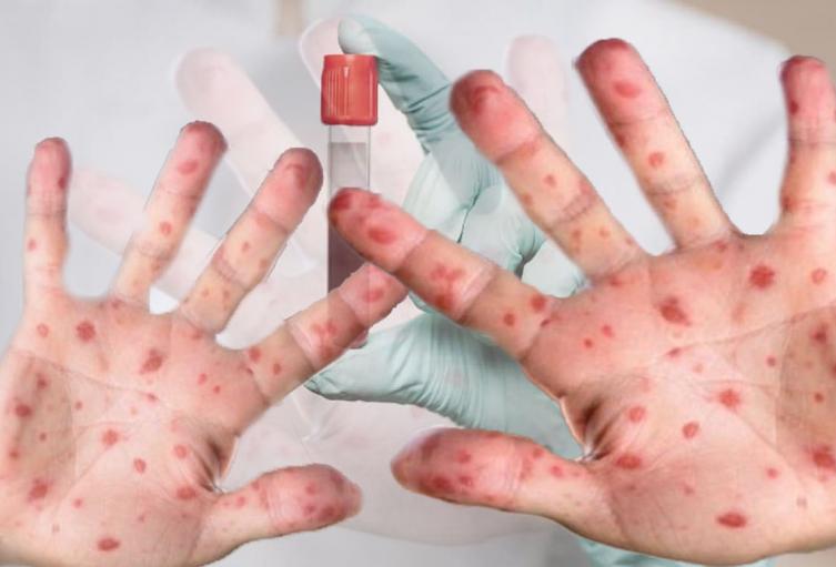 La OMS cambia el nombre de la ‘viruela del mono’ a mpox